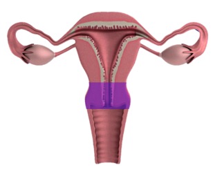 Pelvic Inflammatory Disease – What It Is and What To Do About It